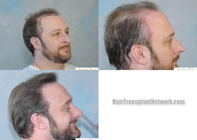 Hair transplantation surgery before and after images