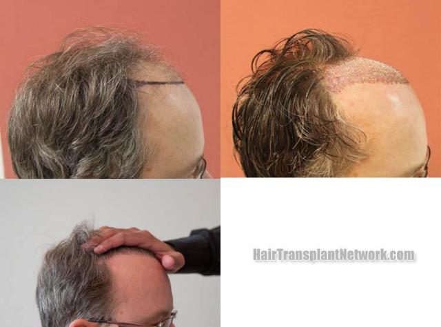 Hair transplantation surgery before and after photos