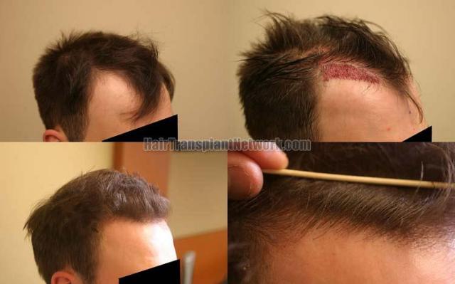 Hair transplantation surgery before and after photos