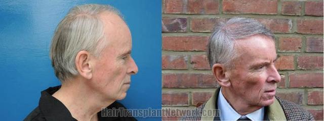 Hair transplantation surgery before and after photos