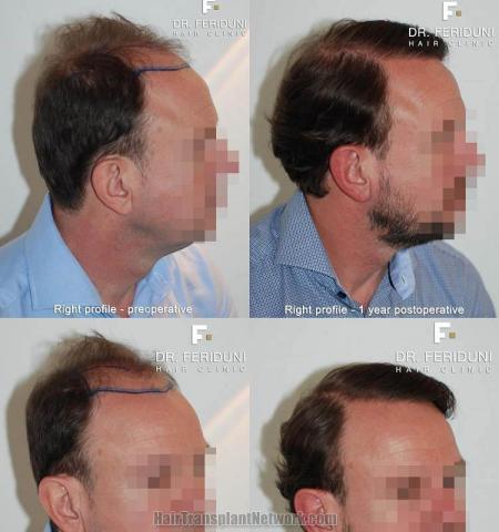 Hair restoration procedure before and after results