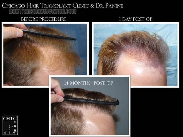 Hair transplantation surgery before and after images