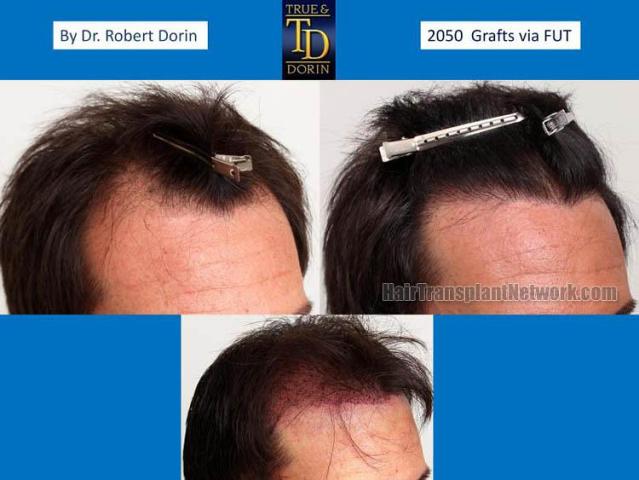 Hair transplantation surgery before and after images