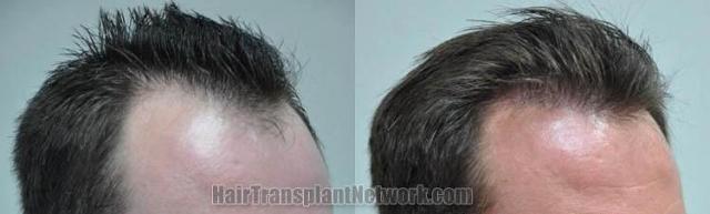 Hair transplantation surgery before and after photos