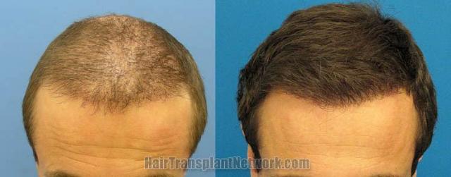 Tilt down view before and after hair transplant