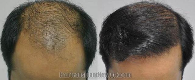 Hair transplantation surgery before and after pictures