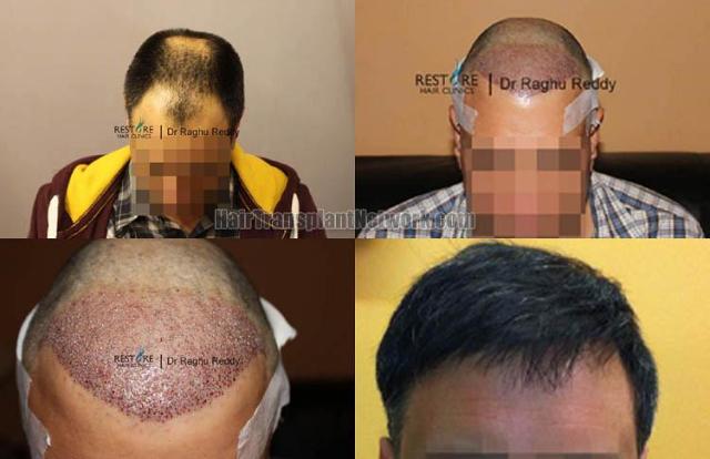 Hair restoration procedure before and after results