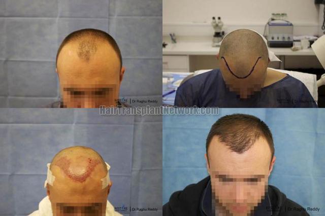 Hair transplantation surgery before and after photos