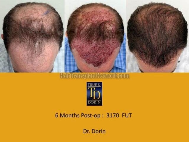 Hair transplantation surgery before and after photos