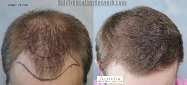 Hair restoration procedure before and after results