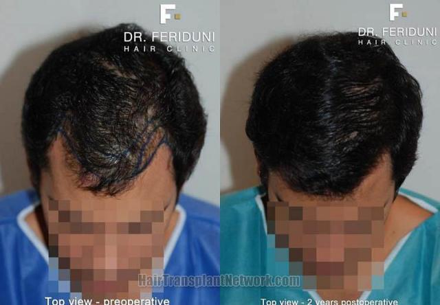 Hair transplantation surgery before and after photos