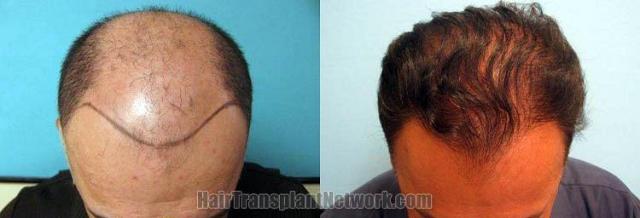 Hair transplantation surgery before and after photos