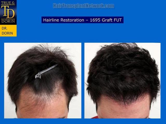 Hair transplantation surgery before and after photos