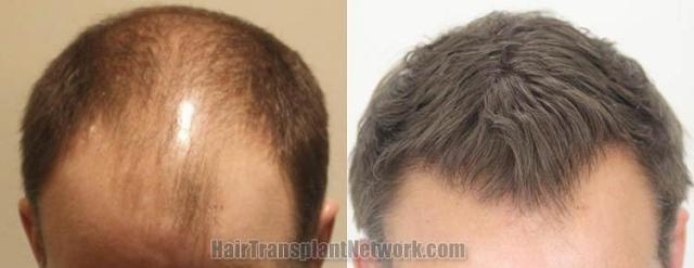 Hair transplantation surgery before and after images