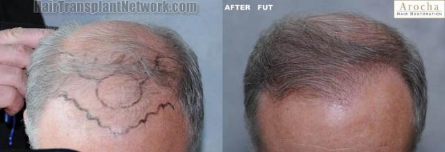 Hair transplantation surgery before and after images