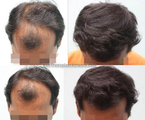 Hair transplantation surgery before and after photos