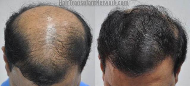 Top view - Before and after surgical hair replacement