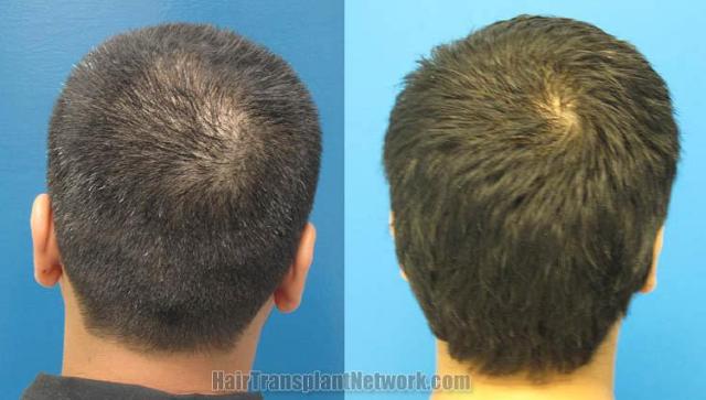 Hair transplantation surgery before and after images