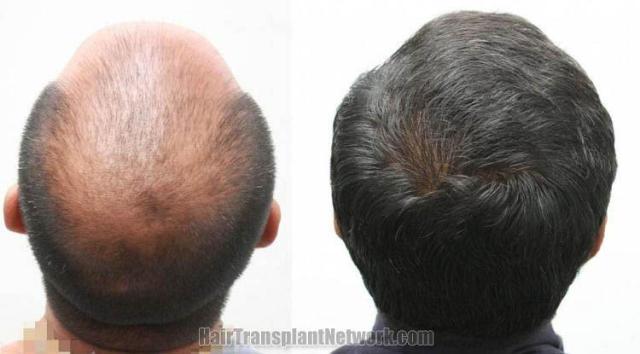 Back view before and after hair transplantation photos