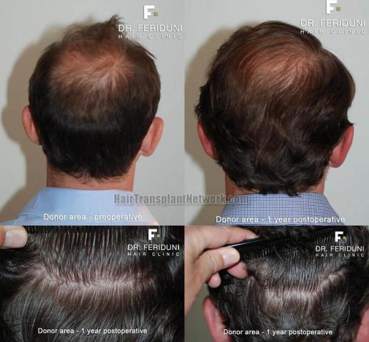 Hair transplantation surgery before and after images