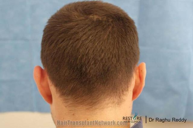 Hair transplantation surgery before and after pictures