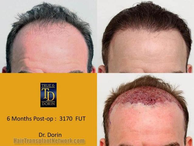 Hair restoration procedure before and after results