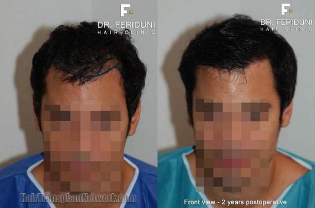 Hair restoration procedure before and after results