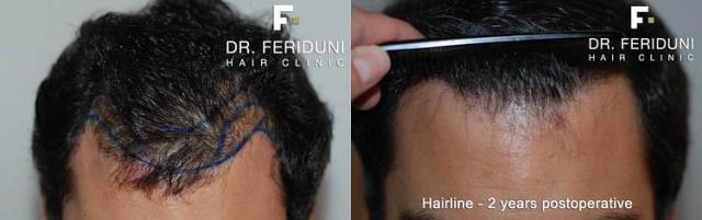 Hair restoration surgery before and after images