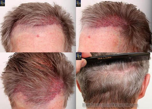 Hair transplantation surgery before and after pictures