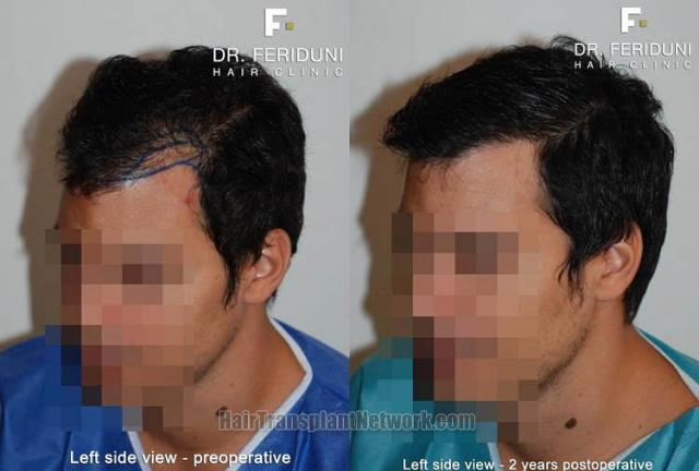 Hair transplantation surgery before and after pictures