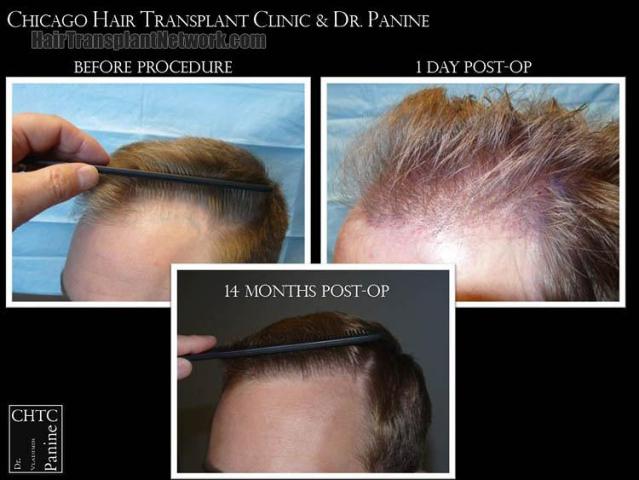 Hair transplantation surgery before and after pictures