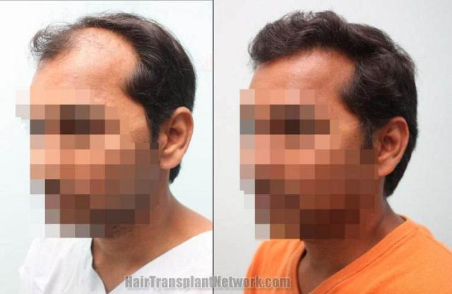 Hair transplantation surgery before and after pictures