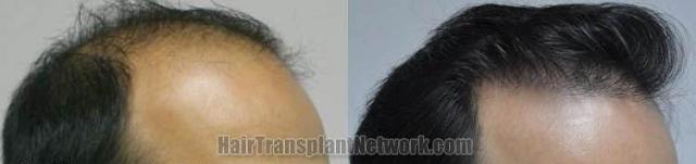 Hair restoration procedure before and after results