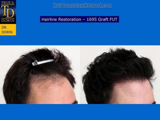 Hair transplantation surgery before and after images