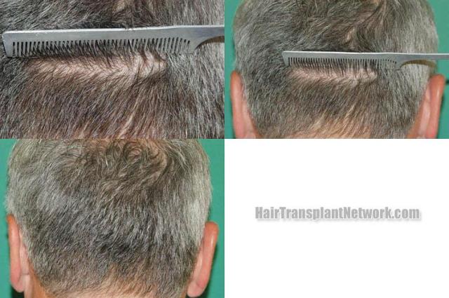 Hair transplantation surgery before and after images