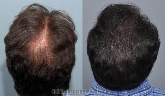 Hair transplantation surgery before and after images