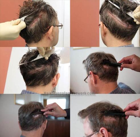 Hair transplantation surgery before and after pictures