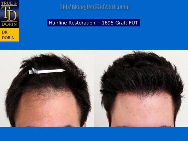 Hair restoration procedure before and after results