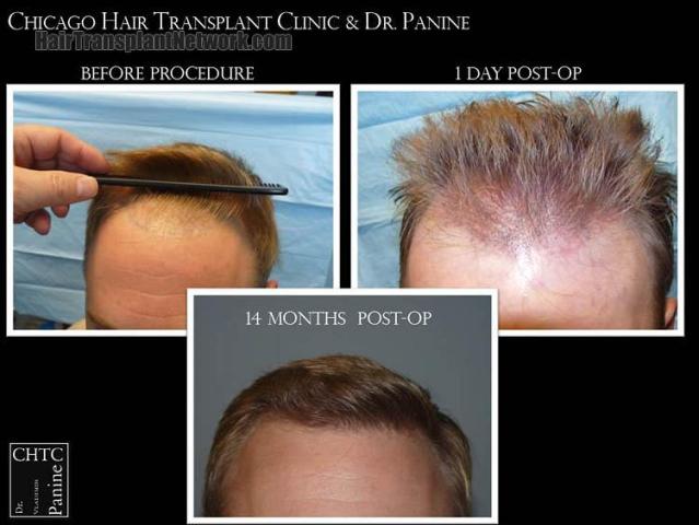 Hair restoration procedure before and after results