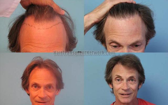 Before and after hair transplant procedure images