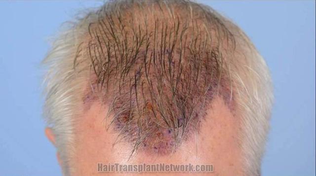 Hair transplant surgery before and after photos