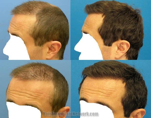 Left side before and postoperative hair transplant images