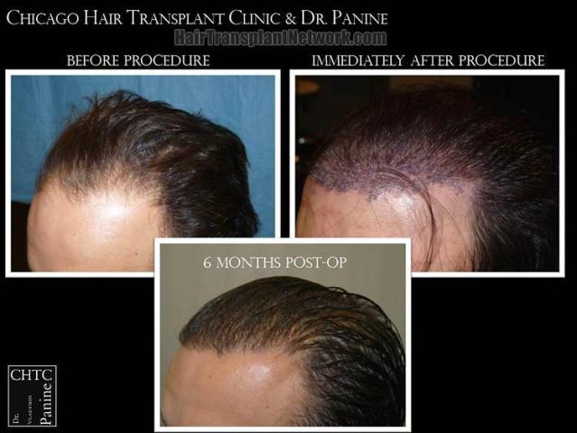 Hair transplantation surgery before and after pictures