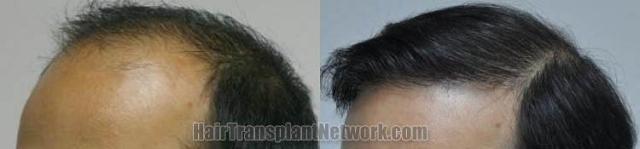 Hair transplantation surgery before and after photos