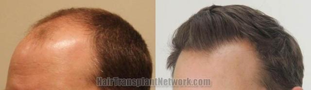 Hair restoration procedure before and after pictures