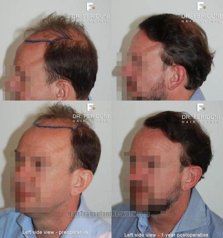 Hair transplantation surgery before and after photos