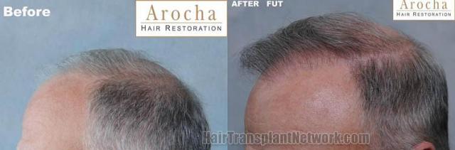 Hair restoration procedure before and after pictures