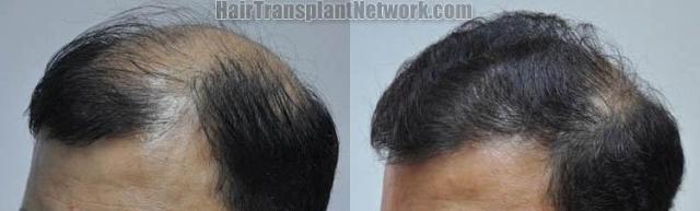 Hair restoration procedure before and after pictures