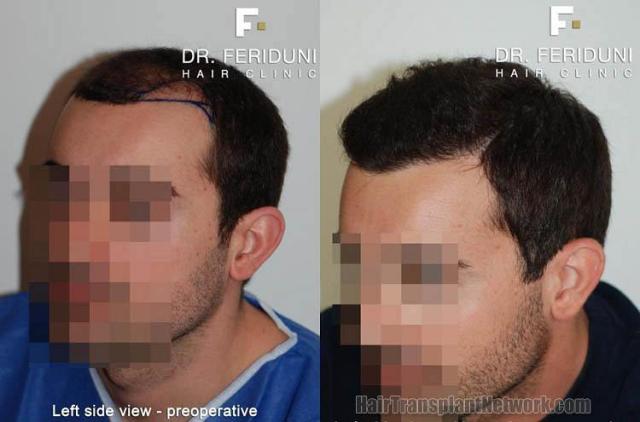 Hair restoration procedure before and after pictures