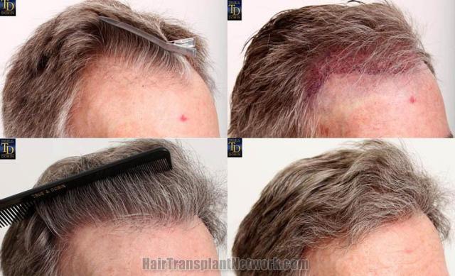 Hair transplantation surgery before and after photos